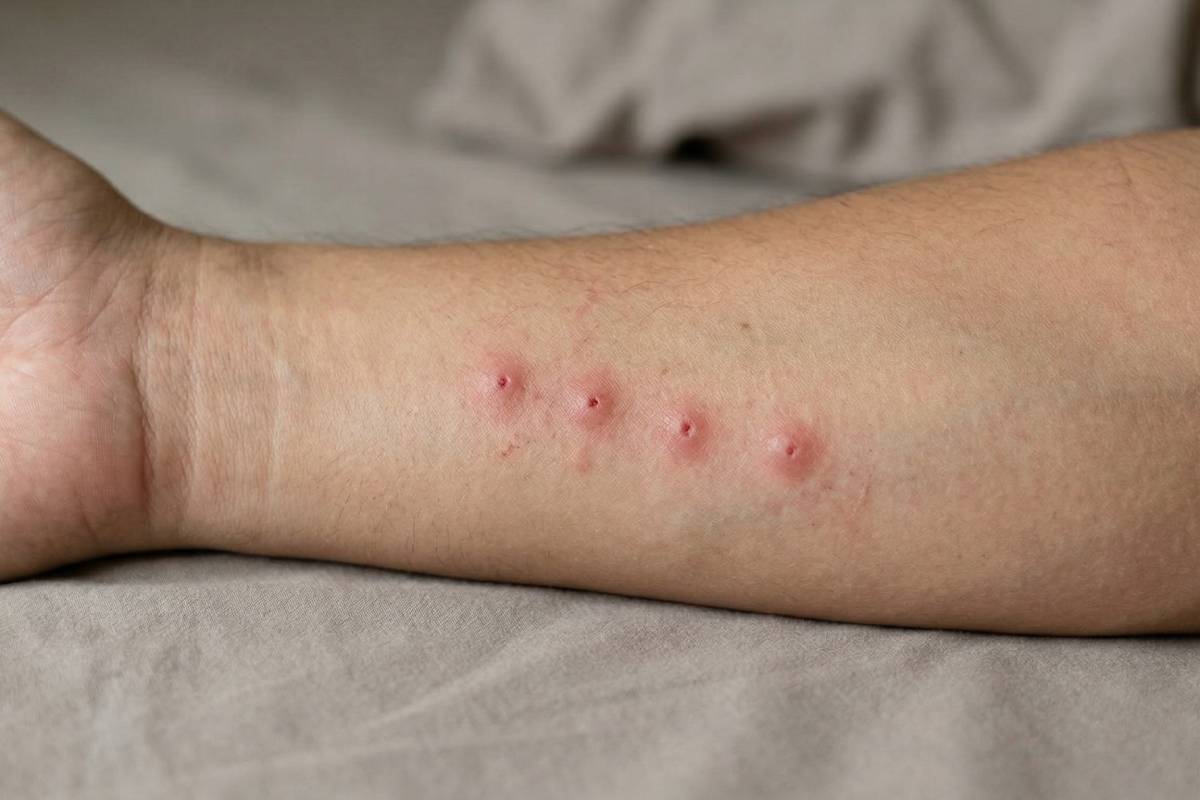 bed bug bites vs mosquito bites comparison on skin